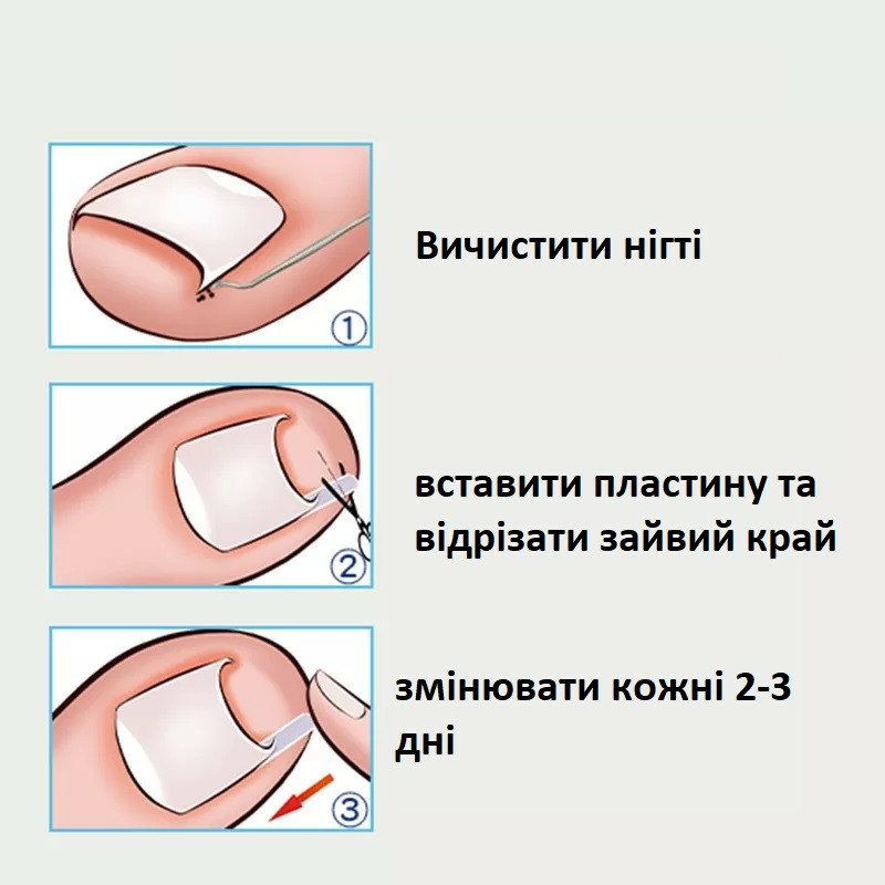 Набор для лечения вросшего ногтя, фото №3